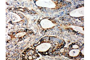 Anti-Integrin alpha 3 antibody,  IHC(P) IHC(P): Human Intestinal Cancer Tissue (ITGA3 Antikörper  (N-Term))