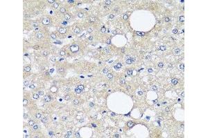 Immunohistochemistry of paraffin-embedded Human liver cancer using AFP Monoclonal Antibody at dilution of 1:12. (alpha Fetoprotein Antikörper)