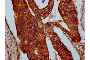 IHC image of ABIN7169703 diluted at 1:400 and staining in paraffin-embedded human colon cancer performed on a Leica BondTM system. (SIRPB1 Antikörper  (Isoform 3))