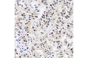 Immunohistochemistry of paraffin-embedded human uterine cancer using C antibody (ABIN7266546) at dilution of 1:100 (40x lens). (CAND1 Antikörper  (AA 750-980))