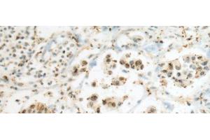 Immunohistochemistry of paraffin-embedded Human breast cancer tissue using SEPHS1 Polyclonal Antibody at dilution of 1:80(x200) (SEPHS1 Antikörper)