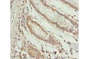 Immunohistochemistry of paraffin-embedded human colon cancer using ABIN7151996 at dilution of 1:100 (ERLIN2 Antikörper  (AA 212-339))