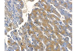 ABIN6259817 and ABIN6268680 at 1/100 staining Human liver cancer by IHC-P.