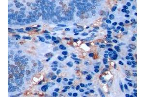 Detection of Ki-67 in Human Colorectal cancer Tissue using Polyclonal Antibody to Ki-67 Protein (Ki-67) (Ki-67 Antikörper  (AA 3088-3235))