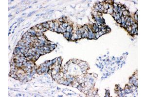 Anti- AIF Picoband antibody, IHC(P) IHC(P): Human Intestinal Cancer Tissue