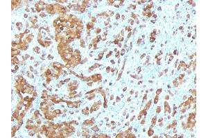 Formalin-fixed, paraffin-embedded human Melanoma stained with Melan-A / MART-1 Mouse Monoclonal Antibody (MLANA/788). (MLANA Antikörper)