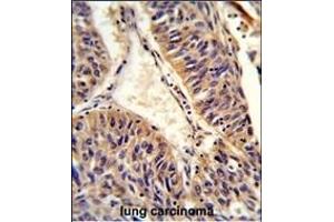 Formalin-fixed and paraffin-embedded human lung carcinoma reacted with ALG14 Antibody (Center), which was peroxidase-conjugated to the secondary antibody, followed by DAB staining. (ALG14 Antikörper  (AA 67-93))