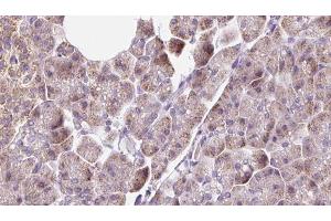 ABIN6273228 at 1/100 staining Human pancreas cancer tissue by IHC-P. (DNAJC19 Antikörper  (Internal Region))
