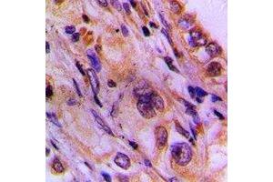 Immunohistochemical analysis of CEP78 staining in human lung cancer formalin fixed paraffin embedded tissue section. (CEP78 Antikörper)