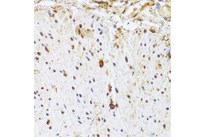 Immunohistochemistry of paraffin-embedded human rectal cancer using CDK4 Antibody. (CDK4 Antikörper  (AA 1-303))