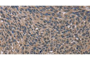 Immunohistochemistry of paraffin-embedded Human lung cancer using IMPDH2 Polyclonal Antibody at dilution of 1:60 (IMPDH2 Antikörper)
