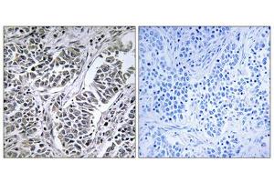 Immunohistochemistry analysis of paraffin-embedded human lung carcinoma tissue using ATP5D antibody. (ATP5F1D Antikörper  (Internal Region))