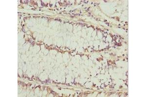 Immunohistochemistry of paraffin-embedded human colon cancer using ABIN7157472 at dilution of 1:100 (KERA Antikörper  (AA 21-352))