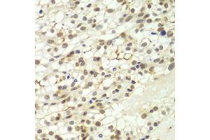 Immunohistochemistry of paraffin-embedded human kidney cancer using LHX4 antibody at dilution of 1:100 (x400 lens). (LHX4 Antikörper)