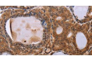 Immunohistochemistry of paraffin-embedded Human thyroid cancer using NDUFA2 Polyclonal Antibody at dilution of 1:30 (NDUFA2 Antikörper)