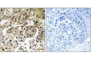 Immunohistochemistry analysis of paraffin-embedded human breast carcinoma, using HP1 alpha (Phospho-Ser92) Antibody. (CBX5 Antikörper  (pSer92))