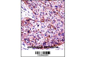 KRT6C Antibody immunohistochemistry analysis in formalin fixed and paraffin embedded human esophagus carcinoma followed by peroxidase conjugation of the secondary antibody and DAB staining.