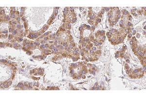 ABIN6279468 at 1/100 staining Human liver cancer tissue by IHC-P.