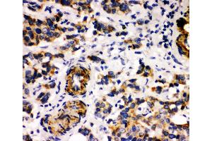 Anti-Human Milk Fat Globule 1 antibody, IHC(P) IHC(P): Human Mammary Cancer Tissue (MFGE8 Antikörper  (Middle Region))