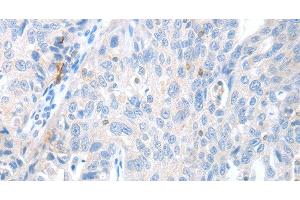 Immunohistochemistry of paraffin-embedded Human ovarian cancer using MAGEB4 Polyclonal Antibody at dilution of 1:40 (MAGEB4 Antikörper)