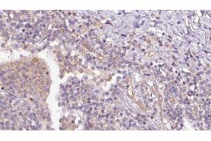 ABIN6273153 at 1/100 staining Human lymph cancer tissue by IHC-P. (RAP1B Antikörper  (C-Term))