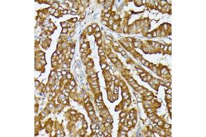 Immunohistochemistry of paraffin-embedded human thyroid cancer using COX15 antibody (ABIN7266634) at dilution of 1:100 (40x lens).