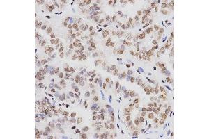 Immunohistochemistry of paraffin-embedded human thyroid cancer tissue using H3K4me1 antibody at dilution of 1:200 (x401 lens). (Histone 3 Antikörper  (H3K4me))