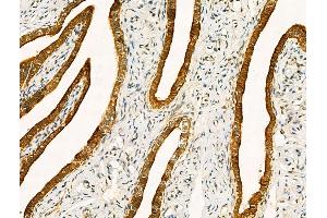 ABIN6261209 and ABIN6268652 at 1/100 staining Human ovarian cancer and adjacent normal tissues by IHC-P.