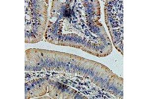 Immunohistochemical analysis of GLUD1 staining in human colon cancer formalin fixed paraffin embedded tissue section. (GLUD1 Antikörper)