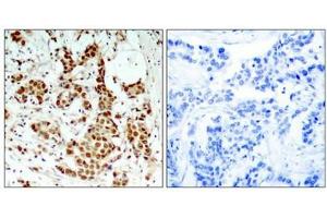 Immunohistochemical analysis of paraffin-embedded human breast carcinoma tissue using p90RSK(Phospho-Thr348) Antibody(left) or the same antibody preincubated with blocking peptide(right). (RPS6KA1 Antikörper  (pThr348))