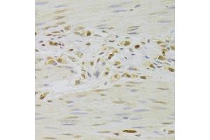 Immunohistochemistry of paraffin-embedded human gastric cancer using PRPF3 Antibody (ABIN5973192) at dilution of 1/100 (40x lens). (PRPF3 Antikörper)