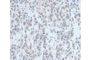 Immunohistochemistry of paraffin-embedded Human gastric cancer using ZNF703 Polyclonal Antibody at dilution of 1:100 (40x lens). (ZNF703 Antikörper)