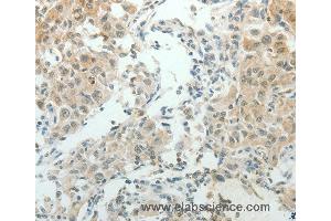Immunohistochemistry of Human lung cancer using NDRG2 Polyclonal Antibody at dilution of 1:50 (NDRG2 Antikörper)