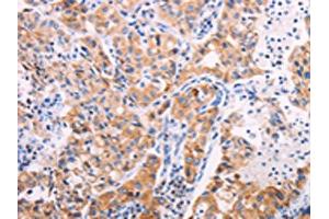 The image on the left is immunohistochemistry of paraffin-embedded Human lung cancer tissue using ABIN7131322(TEKT4 Antibody) at dilution 1/20, on the right is treated with fusion protein. (Tektin 4 Antikörper)