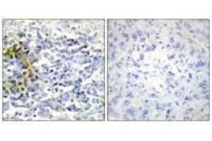 Immunohistochemistry analysis of paraffin-embedded human lung carcinoma tissue using FXR2 antibody. (FXR2 Antikörper)
