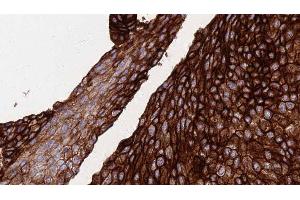 ABIN6276377 at 1/100 staining Human urothelial cancer tissue by IHC-P. (Fatty Acid Synthase Antikörper  (N-Term))