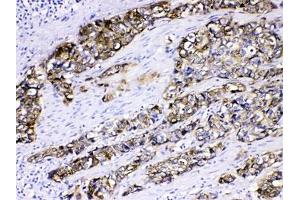 IHC testing of FFPE human esophageal SCC tissue with Cytokeratin 5 antibody at 1ug/ml.