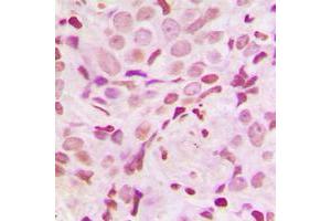 Immunohistochemical analysis of SRF (pS103) staining in human breast cancer formalin fixed paraffin embedded tissue section. (SRF Antikörper  (pSer103))