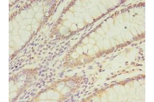 Immunohistochemistry of paraffin-embedded human colon cancer using ABIN7171437 at dilution of 1:100 (CCT6B Antikörper  (AA 101-330))