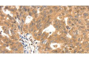 Immunohistochemistry of paraffin-embedded Human ovarian cancer tissue using SCN5A Polyclonal Antibody at dilution 1:30 (SCN5A Antikörper)