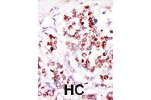 Formalin-fixed and paraffin-embedded human hepatocellular carcinoma tissue reacted with TLK1 polyclonal antibody  , which was peroxidase-conjugated to the secondary antibody, followed by DAB staining. (TLK1 Antikörper  (C-Term))