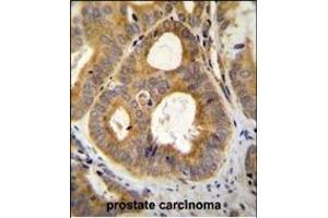 TR Antibody (N-term) (ABIN655614 and ABIN2845095) immunohistochemistry analysis in formalin fixed and paraffin embedded human prostate carcinoma followed by peroxidase conjugation of the secondary antibody and DAB staining. (TRPM8 Antikörper  (N-Term))