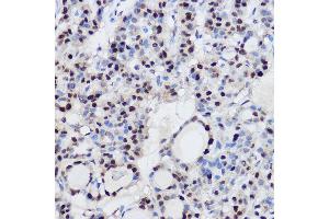 Immunohistochemistry of paraffin-embedded human thyroid cancer using EZH2/KMT6 Rabbit pAb (ABIN6133511, ABIN6140395, ABIN6140399 and ABIN6221414) at dilution of 1:100 (40x lens). (EZH2 Antikörper  (AA 1-250))