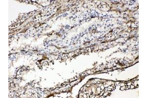IHC testing of FFPE human renal cancer tissue with Hemoglobin antibody at 1ug/ml. (HBA1 Antikörper)