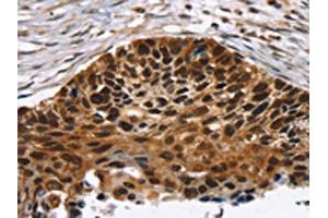 The image on the left is immunohistochemistry of paraffin-embedded Human esophagus cancer tissue using ABIN7192726(TACC2 Antibody) at dilution 1/30, on the right is treated with synthetic peptide. (TACC2 Antikörper)