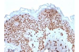 Formalin-fixed, paraffin-embedded human Basal Cell Carcinoma stained with Emerin Mouse Monoclonal Antibody (EMD/2167). (Emerin Antikörper  (AA 56-167))