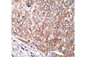 IHC analysis of FFPE human hepatocarcinoma tissue stained with the Nestin antibody (Nestin Antikörper  (AA 1560-1590))