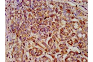IHC image of ABIN7169341 diluted at 1:600 and staining in paraffin-embedded human pancreatic cancer performed on a Leica BondTM system. (SERPINB4 Antikörper  (AA 128-208))