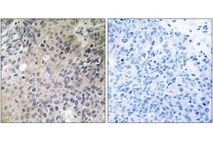 Immunohistochemistry analysis of paraffin-embedded human lung carcinoma tissue, using SHC3 Antibody.