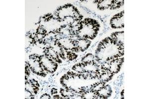 Immunohistochemical analysis of HBP1 staining in human colon cancer formalin fixed paraffin embedded tissue section. (HBP1 Antikörper  (C-Term))